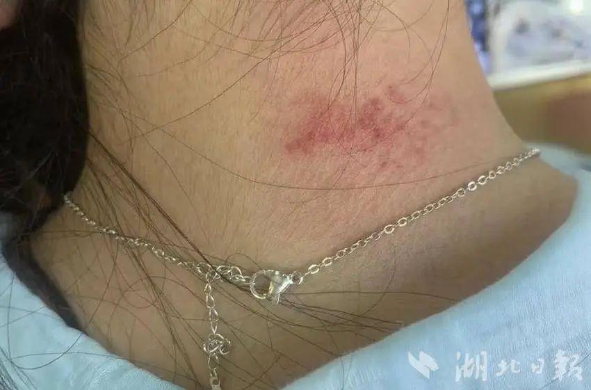 首饰性皮炎” 医生：不要长时间佩戴开元ky棋牌女子戴项链被诊断为“(图2)